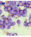 A microscopic image of a bone marrow sample from an AML patient. Image by Heikki Kuusanmäki.
