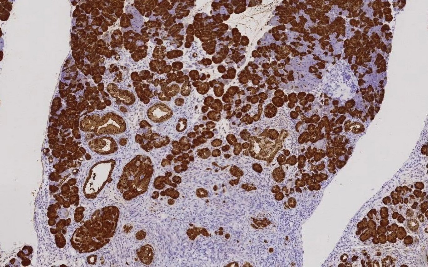 Microscopy image of an early-stage mouse pancreatic tumour (in brown). (Image: Rafa Najumudeen)